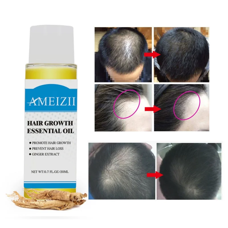 Эфирное масло для роста волос продукты органический натуральный экстракт имбиря уход за выпадением волос сыворотка густая лечебная эссенция 20 мл