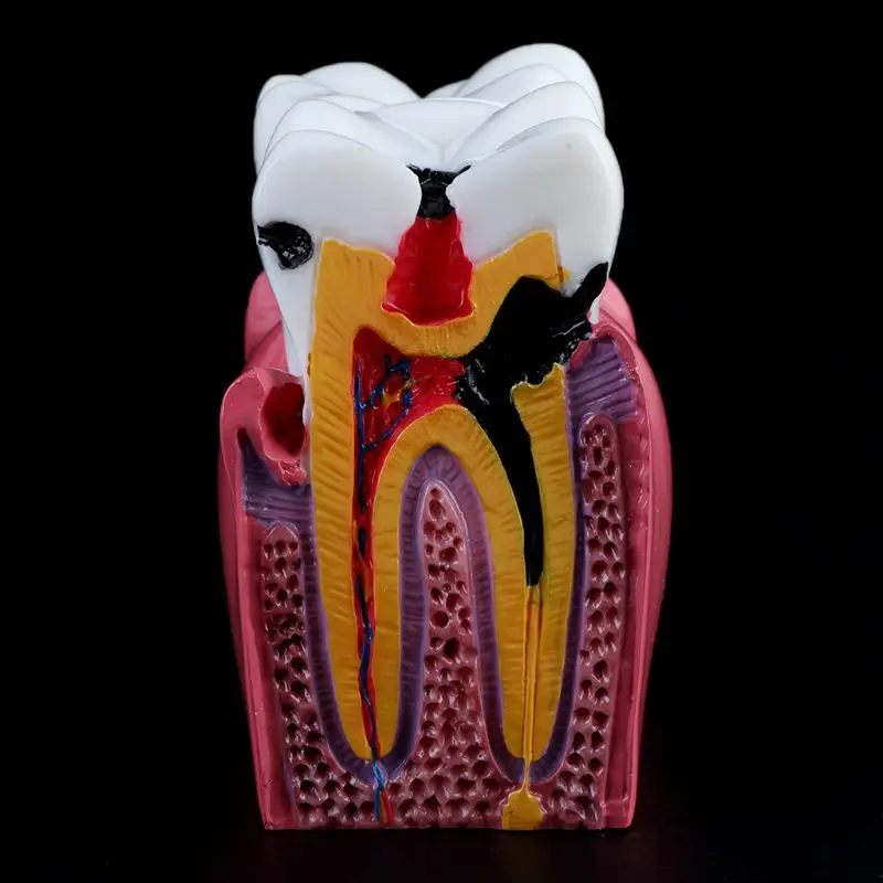 

6 Times Dental Caries Comparation Anatomy Teeth Model for Dental Anatomy Lab Teaching Studying Researching Tool 72XF