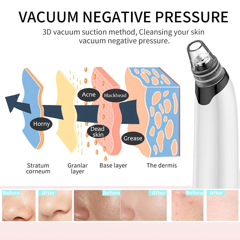 ANLAN Blackhead Remover Face Deep Pore Cleaner Removal Vacuum Suction Acne black head remover tool pimple 2