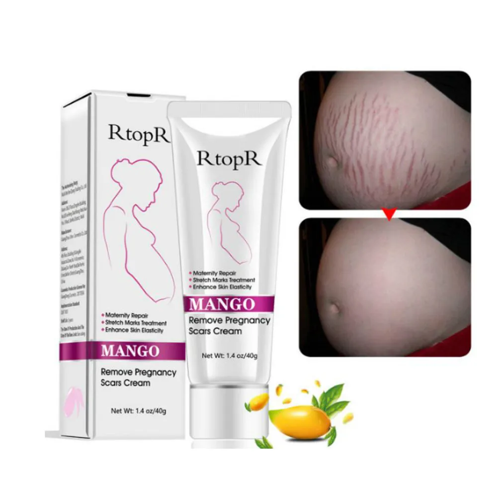 Mango Remove Pregnancy Scars Acne Cream Stretch Marks Treatment Maternity Repair Anti-Aging Anti Winkles Firming Body Creams