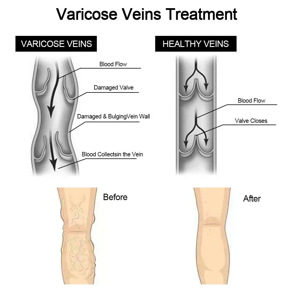 Лечение Варикозного расширения вен крем эффективный уход за здоровьем мазь варикозное расширение вен лечение патч васкулит натуральный раствор травяной