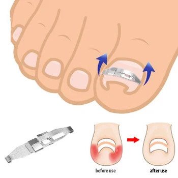 

Foot Care Tool Nail Fixer Corrector Orthotic Pedicure Ingrown Toenail Correction Treatment