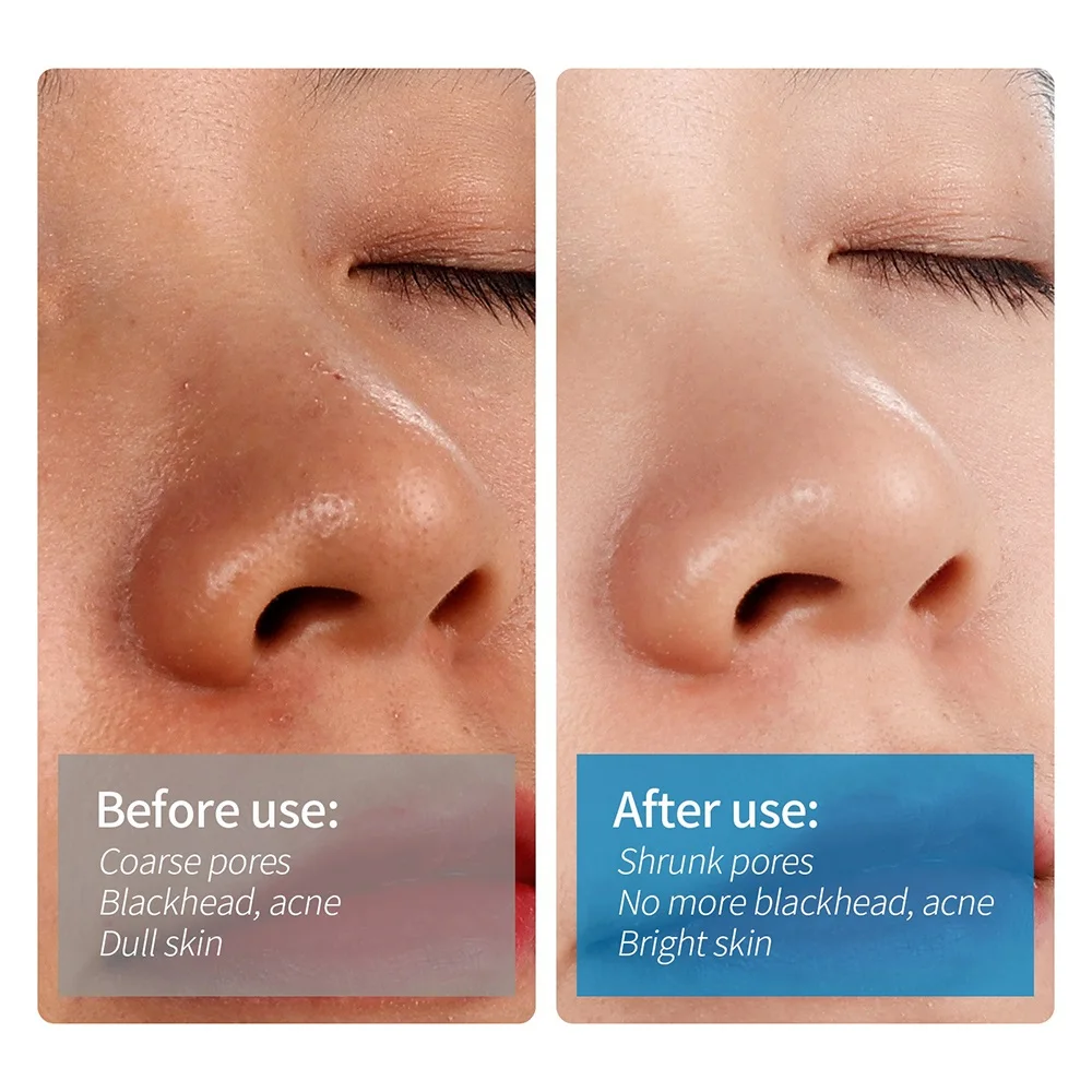 Pimple Removal, Dispositivo de limpeza profunda facial