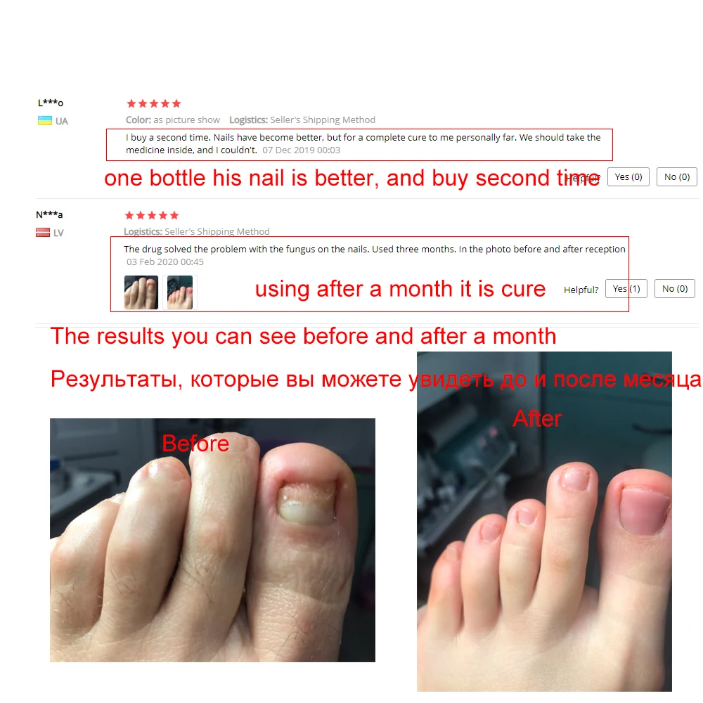Kill 99 9 Bacteria Nail Care Treatment Nail Fungus Oil Onychomycosis Paronychia Anti Fungal Nail Infection Repair Treatment 5ml Aliexpress Beauty Health