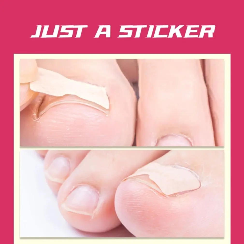 Nail tape stickers Anti-roll nails glue-free toe inlay nails corrector nail patch pull manicure dedicated sticker
