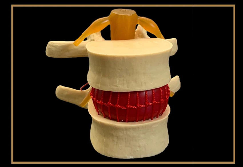 Herniation Demonstration Model, Modelo de Coluna Humana-Branco, Amarelo