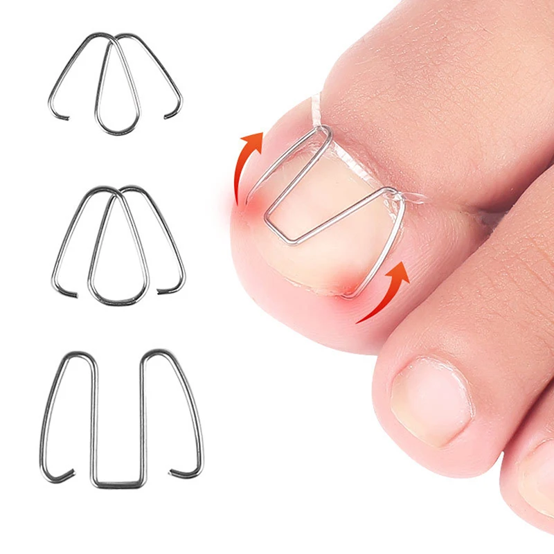 Stainless Ingrown Foot Care Tool Toe Nail Fixer Pedicure Recover Embed Toenail Correction Lifter Kit Inset Buckle | Красота и