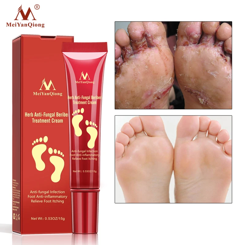 Toe Fungal Infection lupon.gov.ph