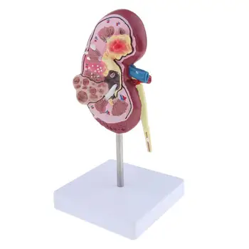 

Anatomical Model Diseased Kidney Model Kidney Model Human Organs Internal Model Anatomical