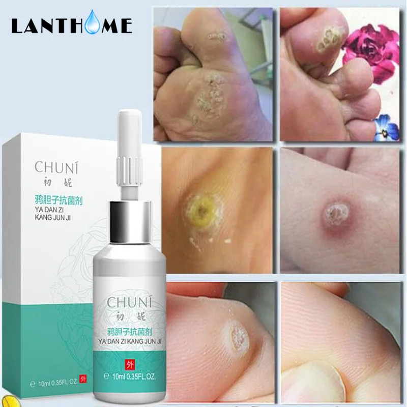 Painless Mole Skin Dark Spot Repair Tag Solution Face Wart Freckle Cream Oil |