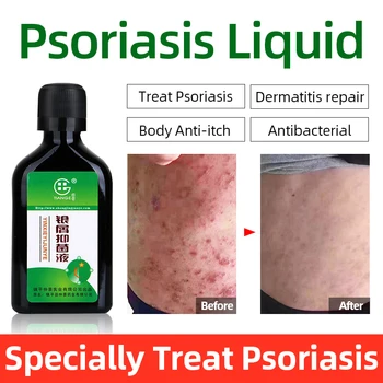 

Herbal Medicine Psoriasis Antibacterial Liquid Body Psoriasis Treatment Care Work Perfect For Kinds Of Skin Dermatitis Allergy