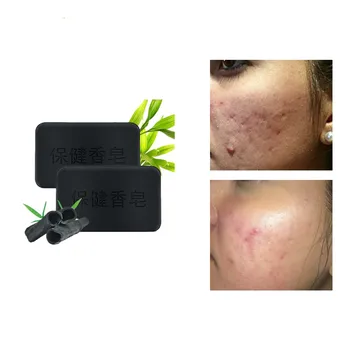 

Active bamboo charcoal soap removal acne fseborrheia and eczema facial soap washing removing freckles reduce melanin soap 40g
