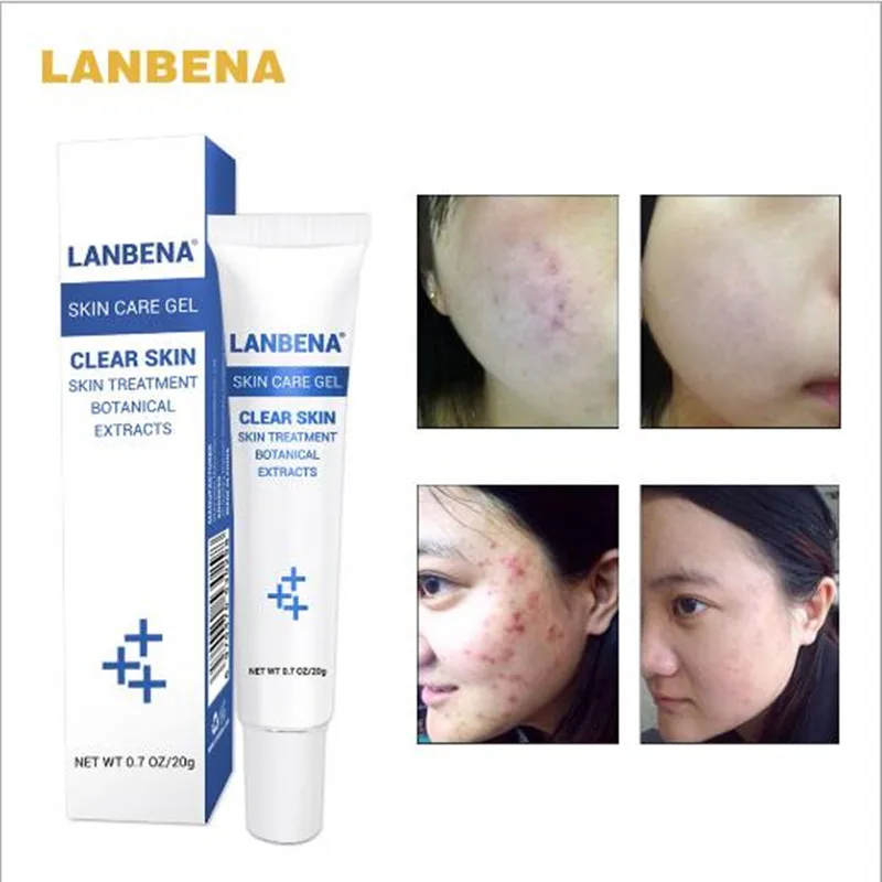 LANBENA Acne Cream For Face Acne Pimples Removal Fade Acne Pimples Marks Skin Care Repair Gel 2