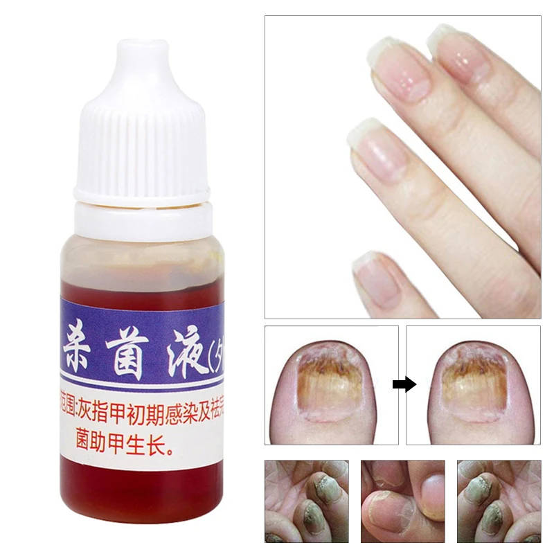 

10ml Liquid Nail Repair Pen Onychomycosis Anti Fungal Toe Fungus Treatment Toe Finger Nail Health Accessories TSLM1