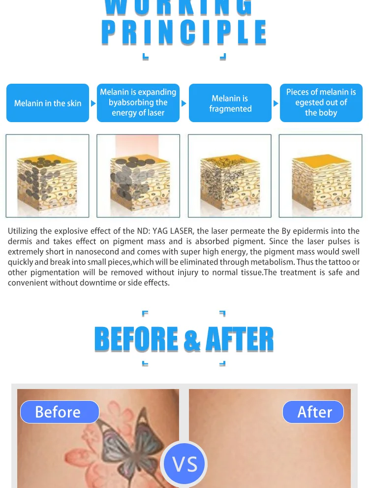 Top level beijing best sell sapphire and ruby q switched picosecond nd yag laser eyebrow tattoo eyeline removal