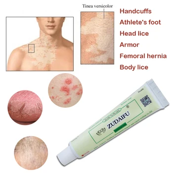 

Profesprofessional Cure Psoriasis Ointment Medicine Ingredient Security For All Kinds Of Skin Problems zudaifu psoriasis cream