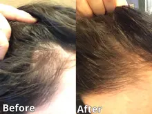 Productos para la pérdida de cabello, Productos naturales sin efectos secundarios para el crecimiento rápido del cabello y el rejuvenecimiento del cabello