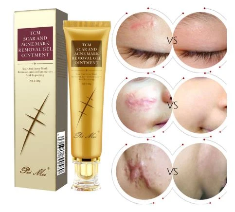 cream for acne marks