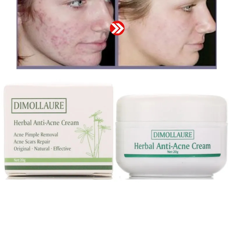 Крем для лица Dimollaure против акне отбеливающий крем лечения прыщей угрей шрамов