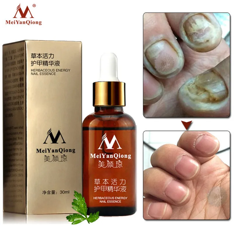 Meiyanqiong Лечение грибка для ногтей Уход за ногами отбеливающая эссенция для пальцев ног против грибка - Цвет: 30ml
