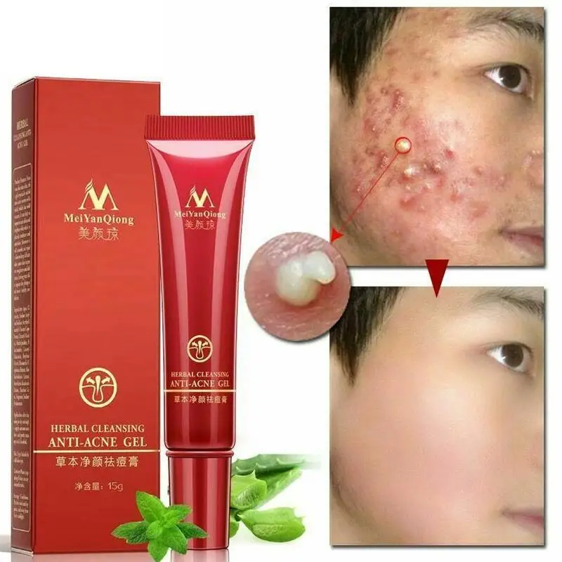 

1pcs Face Acne Cleaning Cream Skin Care Remove Repair Comedone Pimple Acne Quickly Face Acne Cream Remover Anti Acne Treatment