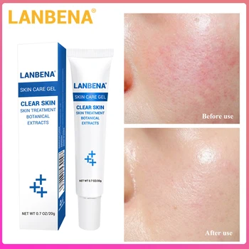 

LANBENA Acne Scar Remove SKin Care Acne Treatment Shrink Pores Gel Bleaching Creams Whitening Moisturizing Face Cream Pimple