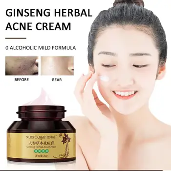 

Ginseng Herbal Acne Cream Anti Pimple Spot Acne Scars Blackhead Removal Cream Whitening Skin Face Care Creams Acne Treament