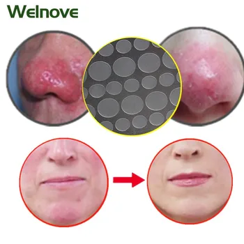 

180pcs=5bags Acne Remover Sticker Anti-Acne Blackhead Treatment Killer Acne Pimple Patch Facial Care Tool Skin Care Mask Plaster