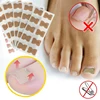 50 stickers  Ingrown Toenail Paronychia Treatment Toe nail repair Nail Correction Stickers ► Photo 2/5