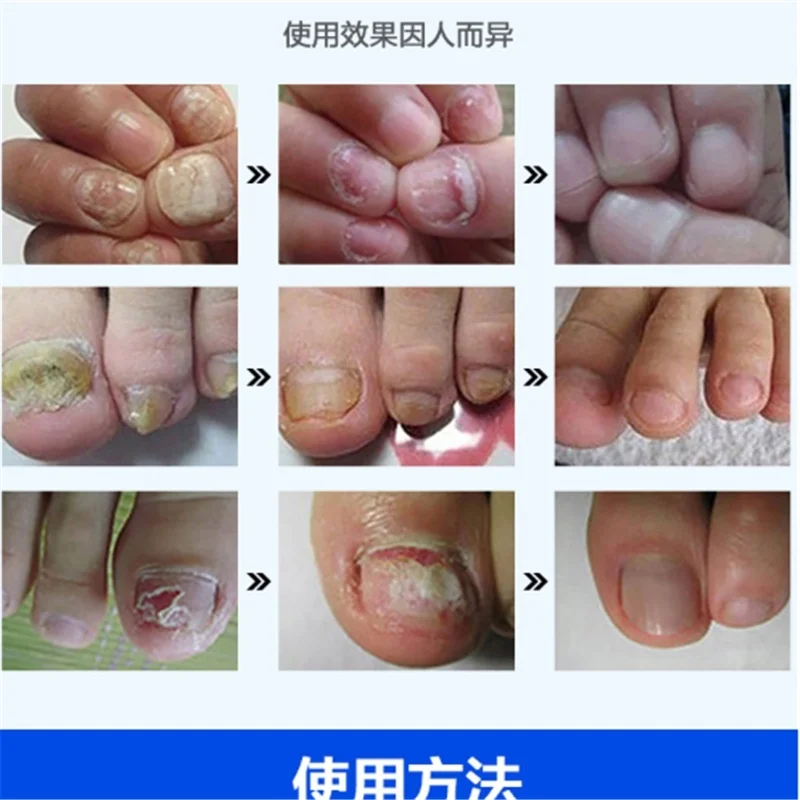 Лечение ногтей от грибка на ногах и рук дезинфекция грибковое лечение масляная