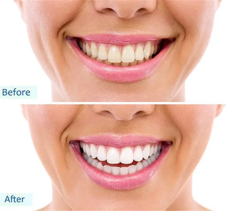 teeth-whitening_95557eba-a44d-4721-9726-ab3f80bfd13b_720x