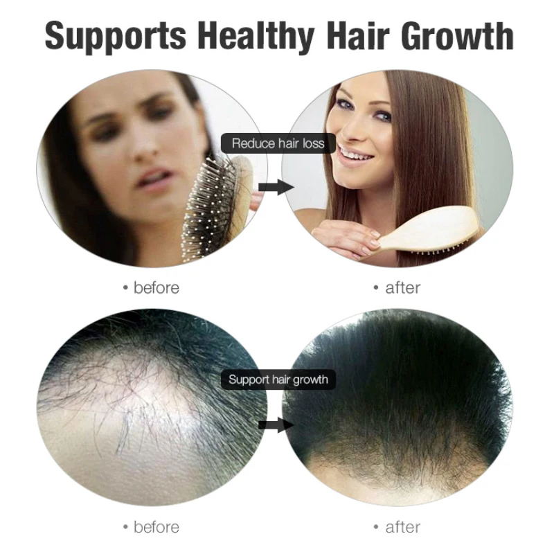 1 шт. 20 мл сывороточная эссенция для роста волос имбирь герминальный рост волос анти Предотвращение выпадения волос алопеция эфирное масло для волос TSLM2
