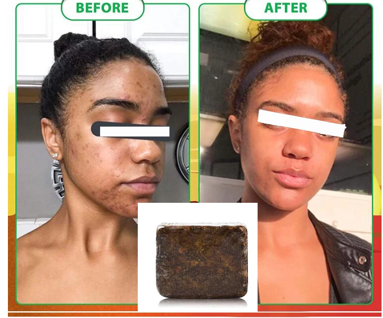 African Black Soap Magic Anti Rebelles Beauty Moisturizing Shea Butter