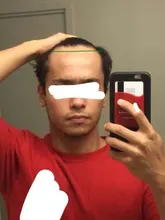 Cuidado del cabello para el crecimiento del cabello aceites esenciales esencia Original auténtico 100% pérdida de cabello líquido salud belleza suero denso para el crecimiento del cabello