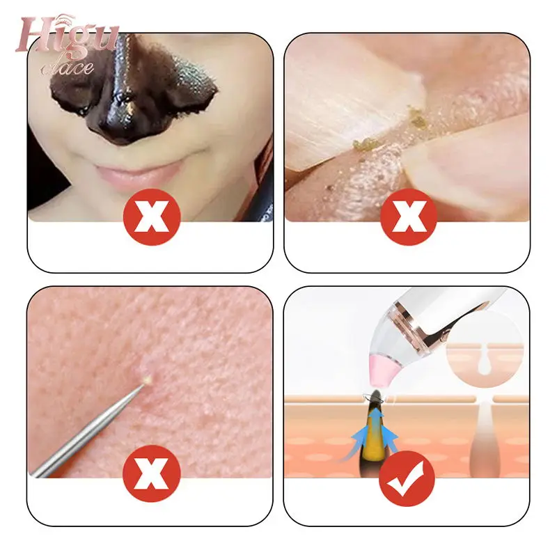 Blackhead Remover (8)