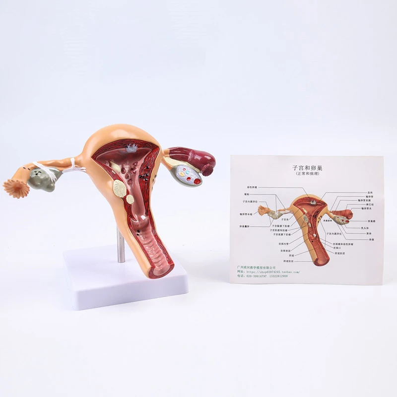 

female reproductive uterus model diseased uterus model teaching aid gynecological anatomy ovary teaching model