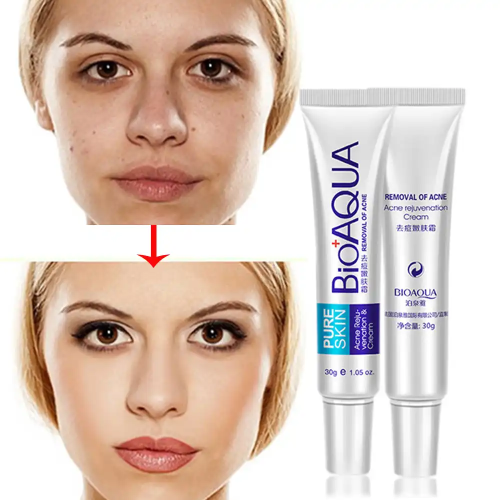 cream for acne rosacea