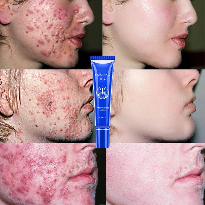 severe acne