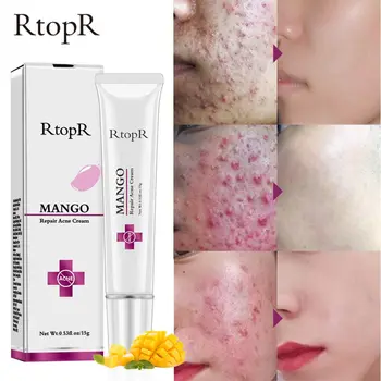 

RtopR Brand Repair Acne Cream Skin Care Anti Acne Spots Face Treatment Scar Blackhead Cream Shrink Pores Whitening Moisturizing
