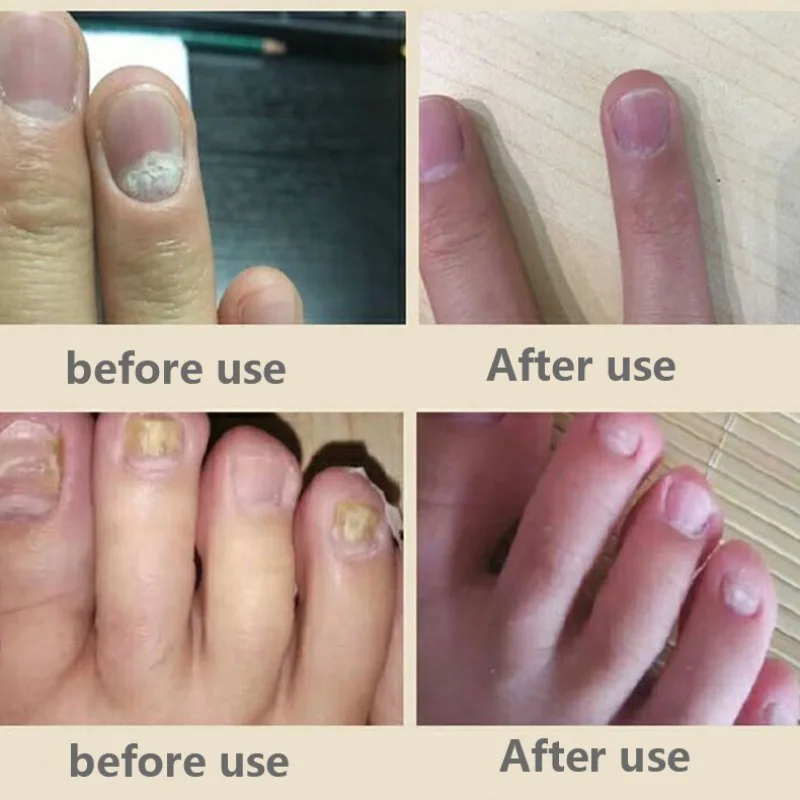 Жидкость для восстановления ногтей, дезинфекция, бактериостатическое анти грибковое лечение онихомикоза, решение для ремонта ногтей, Лечение ногтей