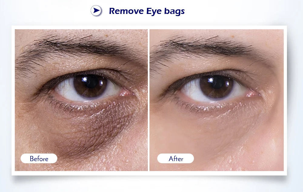 Fóton para Equipamentos de Cuidados com a Pele Aperte a Máquina da Beleza Mesotherapy Eletroporação Rosto Beleza Caneta Facial Led Face Lift rf & Ems 15 Rf & ems mesotherapy eletroporação rosto beleza