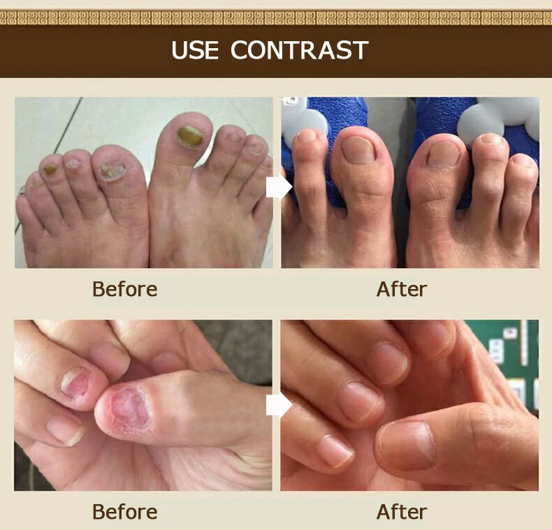 2 шт./лот грибковое Лечение ногтей Onychomycosis Paronychia Уход за ногами эссенция для удаления грибка ногтей Травяной Уход лекарственная жидкость