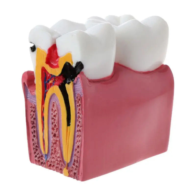 6 раз стоматологические кариес компарация Анатомия зубов Модель для стоматологической анатомии лабораторное обучение исследования