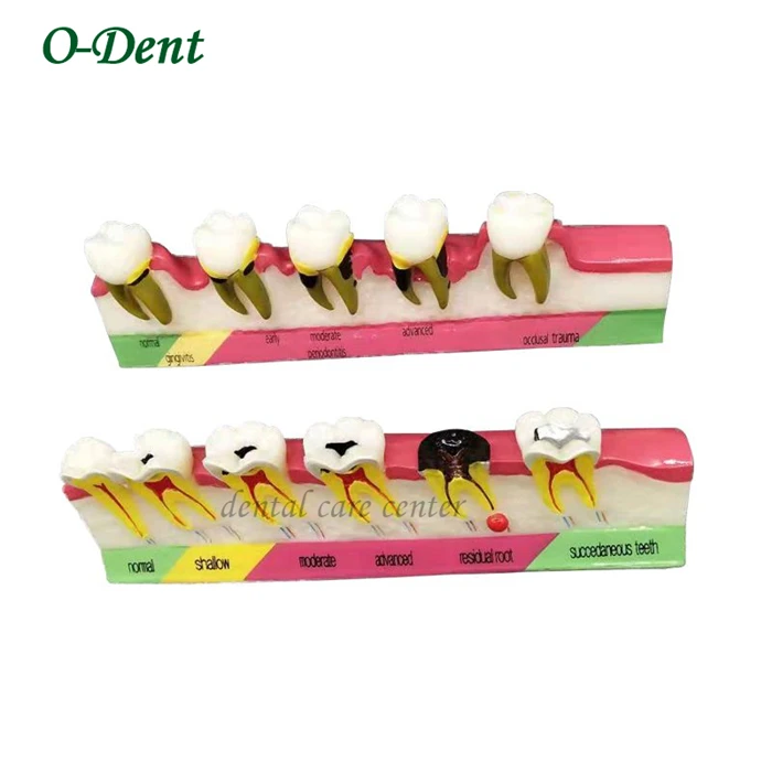 Стоматологическая модель кариеса зубов для корня cannal endodontics пародонтологические патологические болезни ассортирование патологии компарация зубов