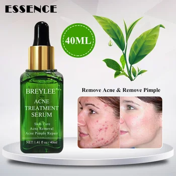 

Hot Anti Acne Removal Essence Remover Pimple Repair Shrink Pores Face Skin Care 40ml MP789