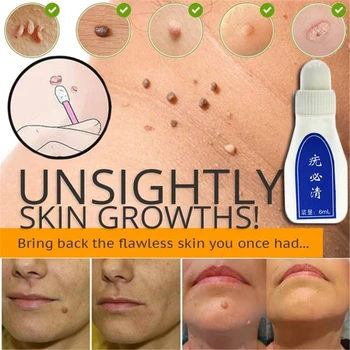 

Ultra Strength Skin Tag Remover 12 hours Tu kill Medical Tu kill Remover Foot Corn Skin Tag Mole & Genital Wart Remover 6ml