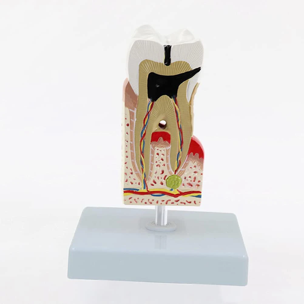 Tooth Pathological Disease Caries Medical Science Teaching Resources