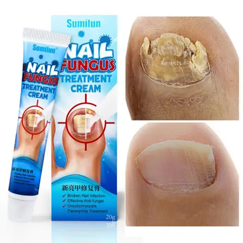 Effective Nail Treatments Cream Nail Fungus Removal Cream Onychomycosis Paronychia Soft Nail Toenail Repair Ointment 20g