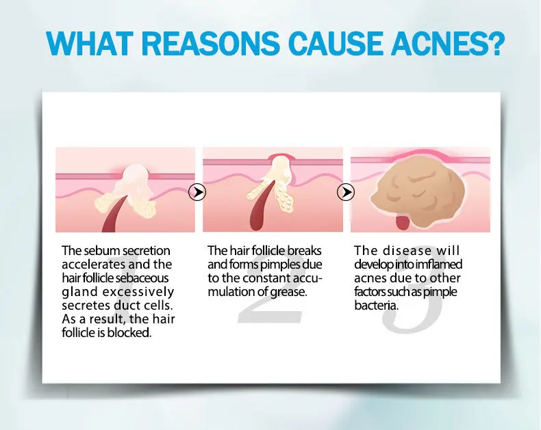 anti-acne_06