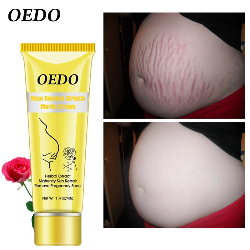 cream that can remove stretch marks
